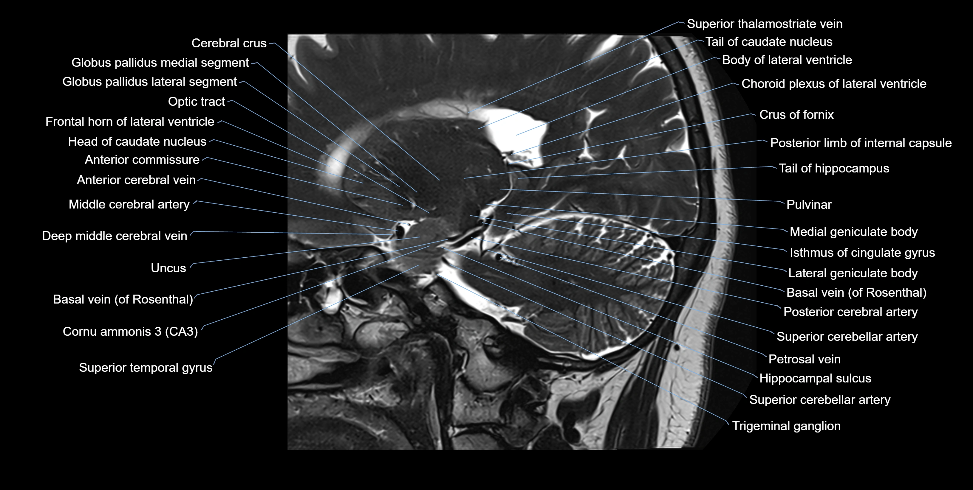 hippocampus sagittal cross sectional anatomy 3T MRI images -img-100010.webp